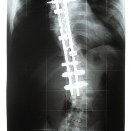 Spinal Cord Injuries in Los Angeles