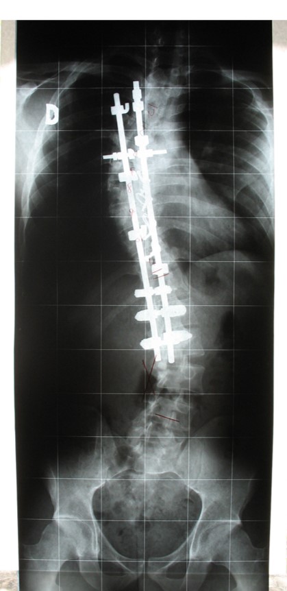 Spinal Cord Injuries in Los Angeles